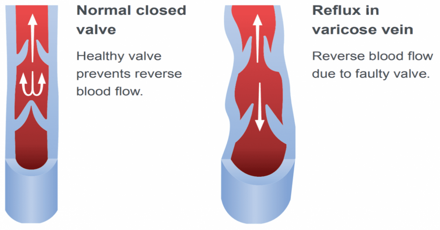 Normal veins VS varicose veins