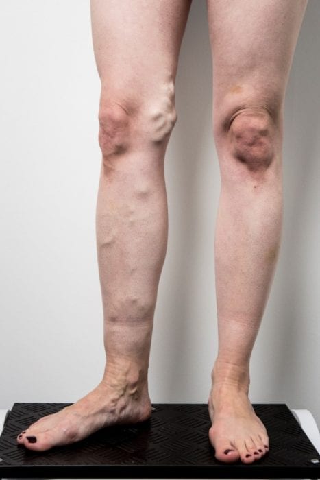 Legs before varicose veins treatment