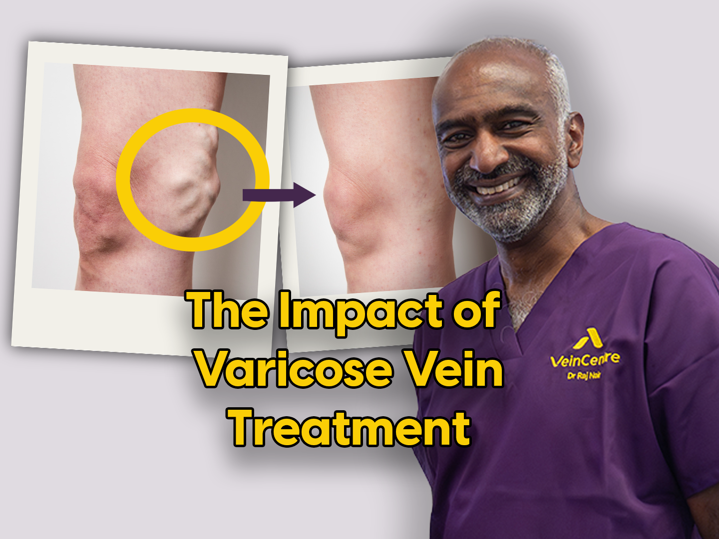 Varicose Vein Treatment Recovery