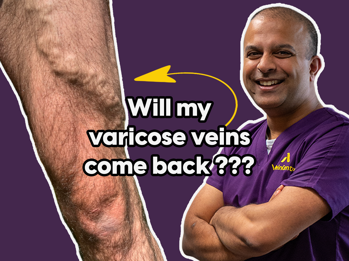 Varicose Vein Myths Busted